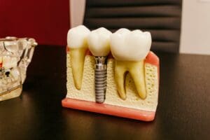 dental implants Asheville